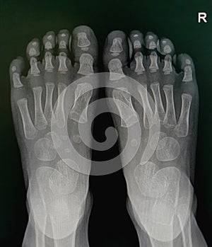 X-rayÃ¢â¬â¹ image, BothÃ¢â¬â¹ footÃ¢â¬â¹ APÃ¢â¬â¹ view, ShowÃ¢â¬â¹ normalÃ¢â¬â¹ pediatric  bone. photo